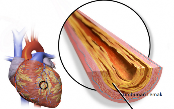 Mengenal Penyakit Jantung